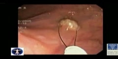 Surgery for Cancer Colon Operation
