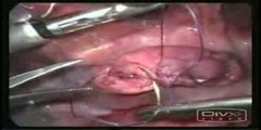 Urinary bladder  laparoscopic repair of rupture