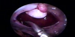 Laparoscopic Orchidopexy Procedure