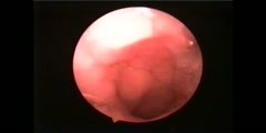 Endoscopic view of Adenoids