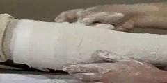 Short Leg Cast - Medical Video