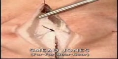 Smead Jones sutures