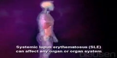 Animation of a systemic lupus erythematosus