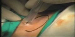 Pilonidal cyst removal with laser