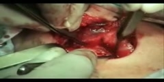 Total Thyroidectomy Surgery Operation Video