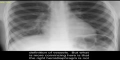 Pneumonia - Chest X-Ray Interpretation