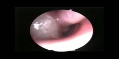 Allergic Nasal polyps Diagnosis