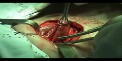 Thyroidectomy Surgery