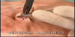 Vertical Mattress Suture Technique