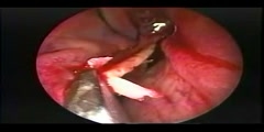 Nasal Septoplasty