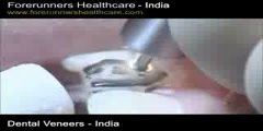 Dental Veneers - India