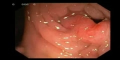 Typical Rectal Cancer Endoscopy