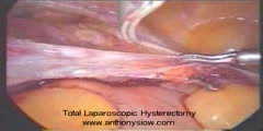 Abdominal hysterectomy procedure  - Scientific Video and  Animation Site
