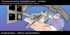 Angioplasty Surgery in India