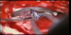 Microneurosurgical Microvascular Decompression in Trigeminal Neuralgia Treatment