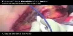 Osteosarcoma Cancer Surgery - India