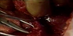 Open Distal Pancreatectomy Surgery Techniques Video