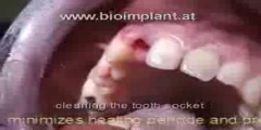 Dental Implant Solution