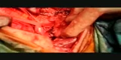 Trachea Resection