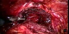 Robotic anastomosis of bladder to urethra video