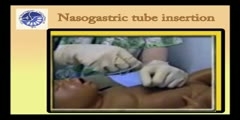 Nasogastric tube placement and feeding