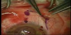 Pterygium Surgery with Auto-Conjunctival Graft Video