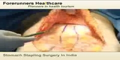 Stomach Stapling Surgery - India