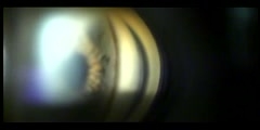 Yag Laser Trabeculoplasty for Glaucoma Video