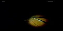 Retina Repair Surgery