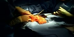 Repair of an Umbilical Hernia