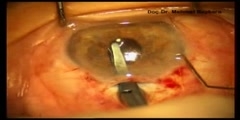 Posterior iris claw lens implantataion