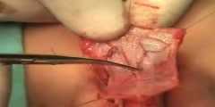 Urethroplasty of the Penile