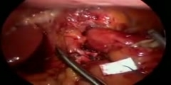 Nissen Laparoscopic Fundoplication Acid Reflux Surgery Stomach