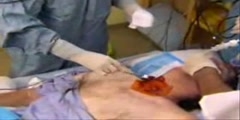 Percutaneous tracheostomy treatment  - Scientific Video and  Animation Site