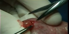 Removal of Mucocele- Surgery