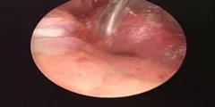Thyroid Surgery Video