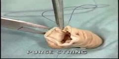 Dermatochirurgie: purse string suture-cheohanoi.vn