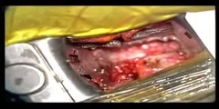Spinal Disc Replacement Part 2