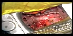 Spinal Disc Replacement