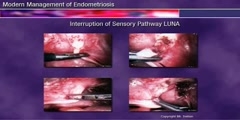 Modern management of endometriosis discussion