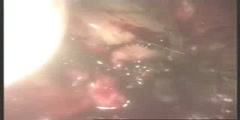 Splenectomy Procedure