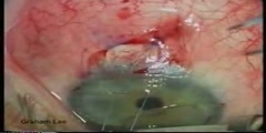 Trabeculectomy of Glaucoma