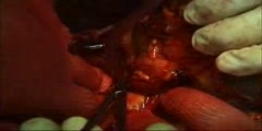 Procedure for open splenectomy