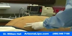 Abdomen Waist Liposuction Video