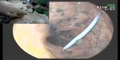 Percutaneous endoscopic colostomy procedure