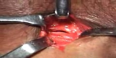 Tracheostomy Emergency Procedure Video