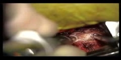Prolapse And Replacement os Spinal Disc - Part 1