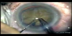 Hard White Cataract with trypan blue Capsule Staining