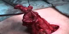 Transverse Colostomy Closure Video