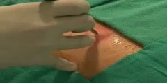 Abscess Incision and Drainage - New England Journal of Medicine